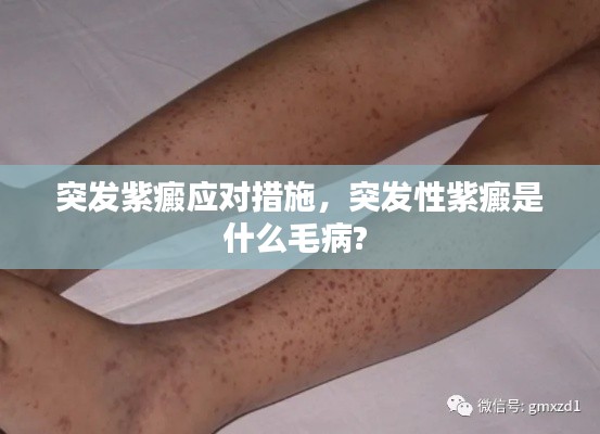 突发紫癜应对措施,突发性紫癜是什么毛病?