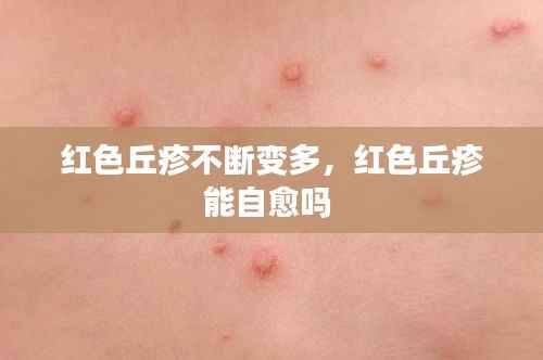 红色丘疹不断变多,红色丘疹能自愈吗